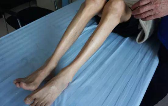 小脑萎缩之后哪些症状对身体伤害最大?_患者_影响_肌肉