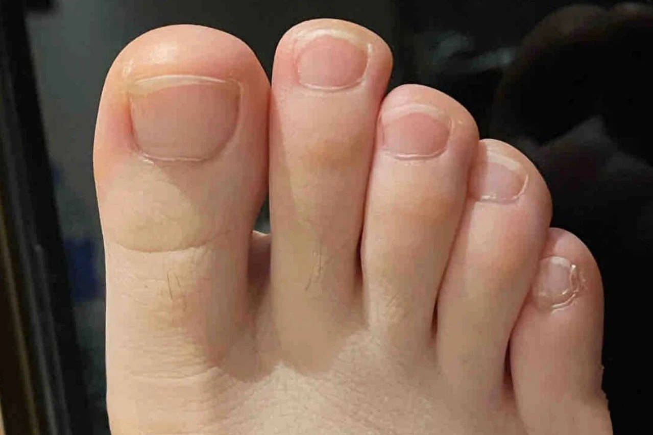 黄厚灰指甲不去拔甲也能掉?按这个方法做!不到30天自己全掉光!