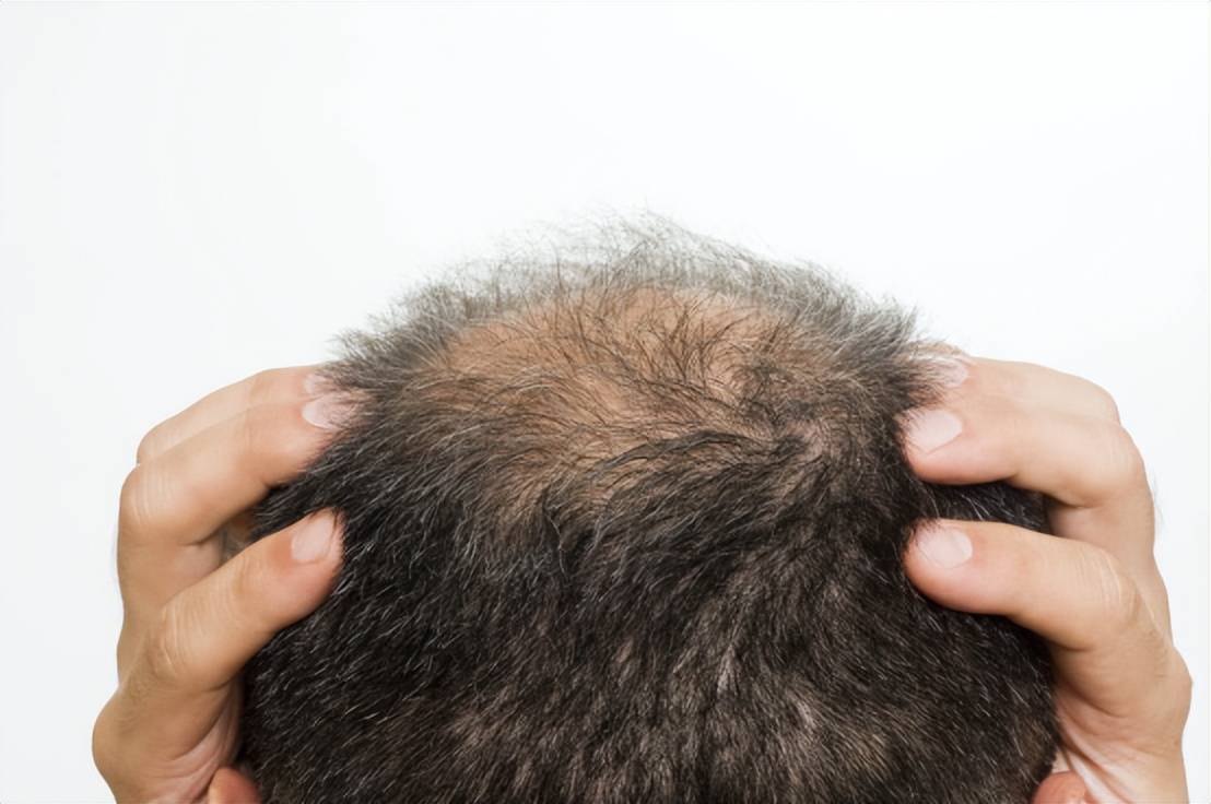 引起男性掉头发的原因有很多,比如有遗传原因,精神原因,内分泌原因