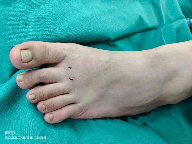 北大医院太原医院(太原市中心医院)开展第二跖趾关节镜治疗术