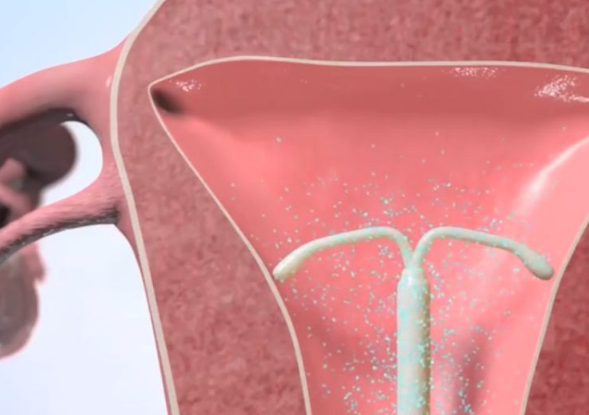 "节育环"能在体内长期放置吗?可能很多女性朋友都没有想过!