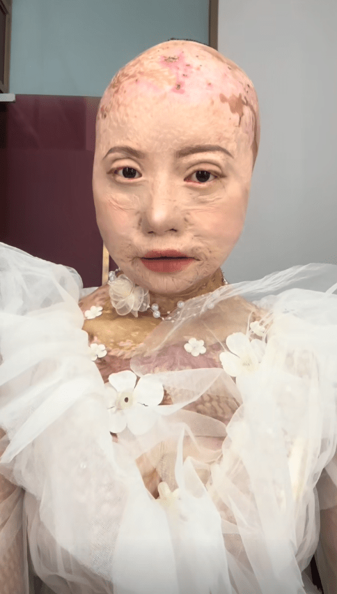 她被大火烧伤历经13次手术坚称不要同情网络粉丝过百万