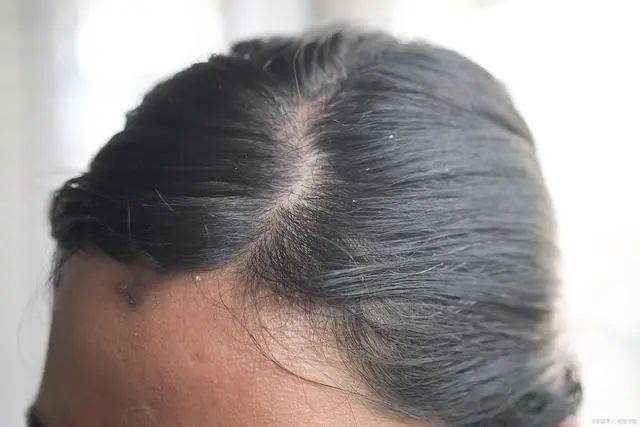 脂溢性脱发是一种与头皮多余油脂分泌过多有关的脱发问题