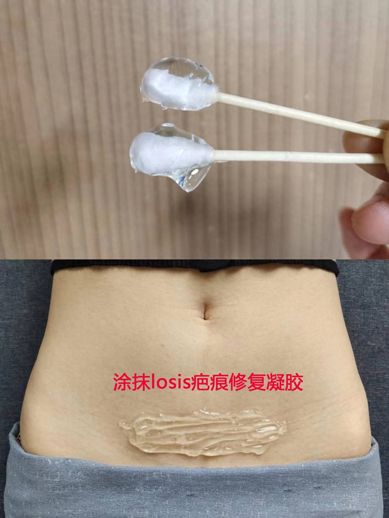 有这么牛的剖腹产疤痕增生淡化方法 在家就能搞定