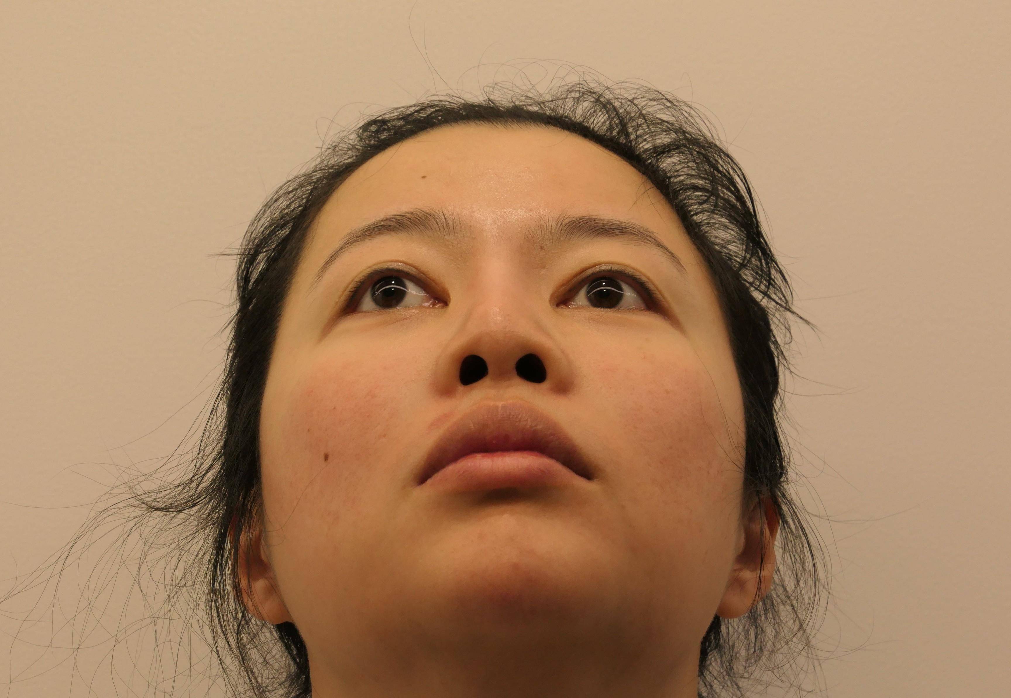 隆鼻后鼻孔越来越外露一不小心就变成猪鼻子了