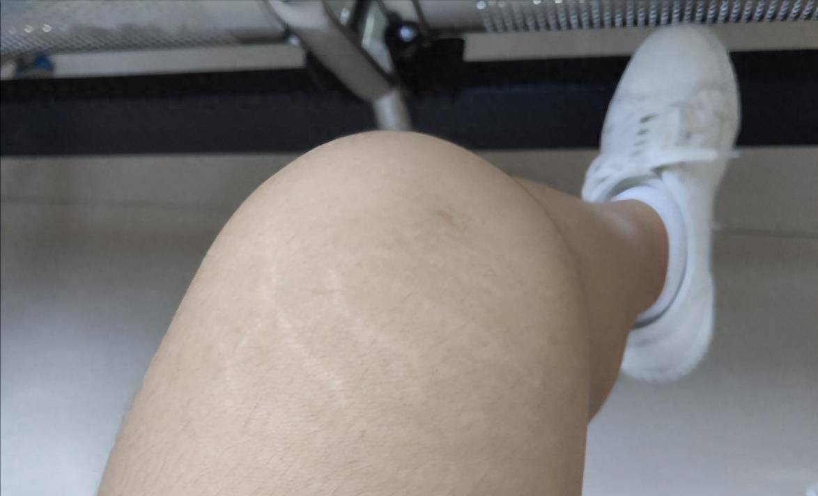 原创来自莉莉的疑惑大腿根突然出现白色纹路我是不是病了