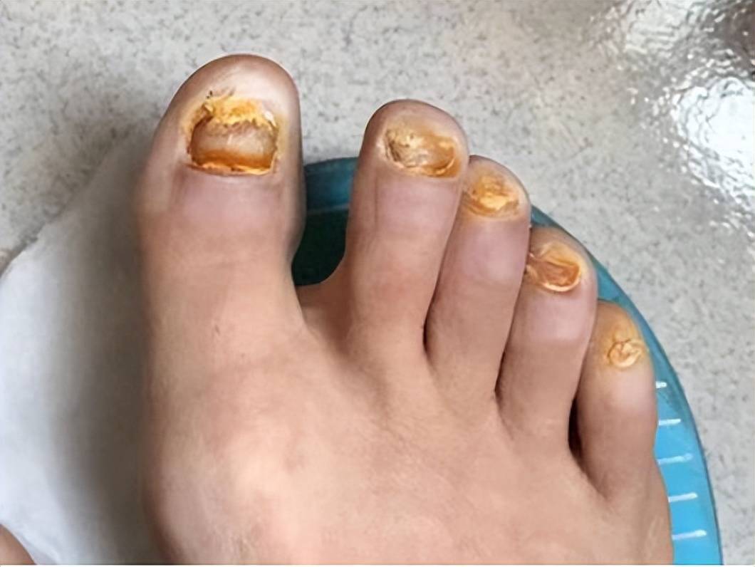 终结灰指甲的秘诀!掌握这几招,才是真正有效的方法!_真菌_朋友_效果