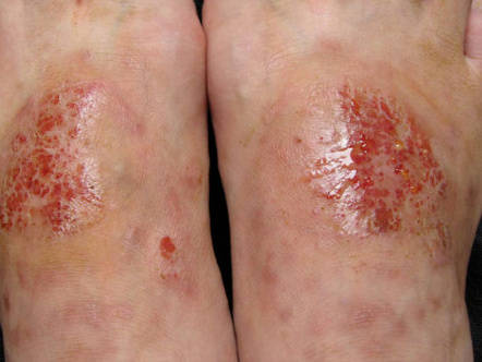 【长沙皮肤病医院挂号】:高发期!湿疹的皮肤问答你知道多少?