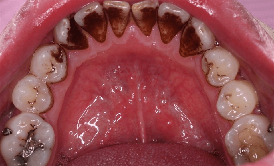 过来人教你3个洁牙妙招,牙齿瞬间亮白如新!_效果_方法_牙垢