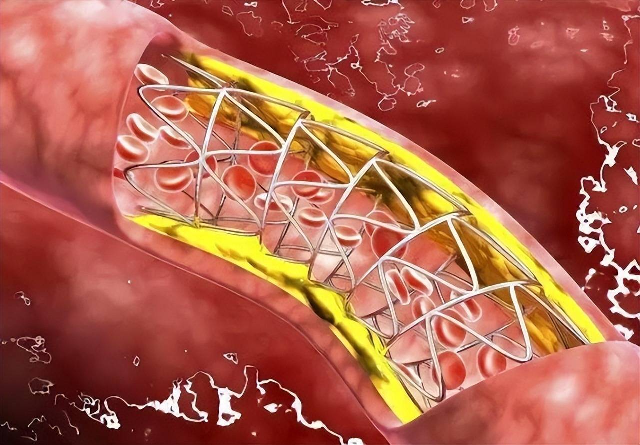 国产心脏支架涨价70倍重返万元时代！背后的真相是什么？