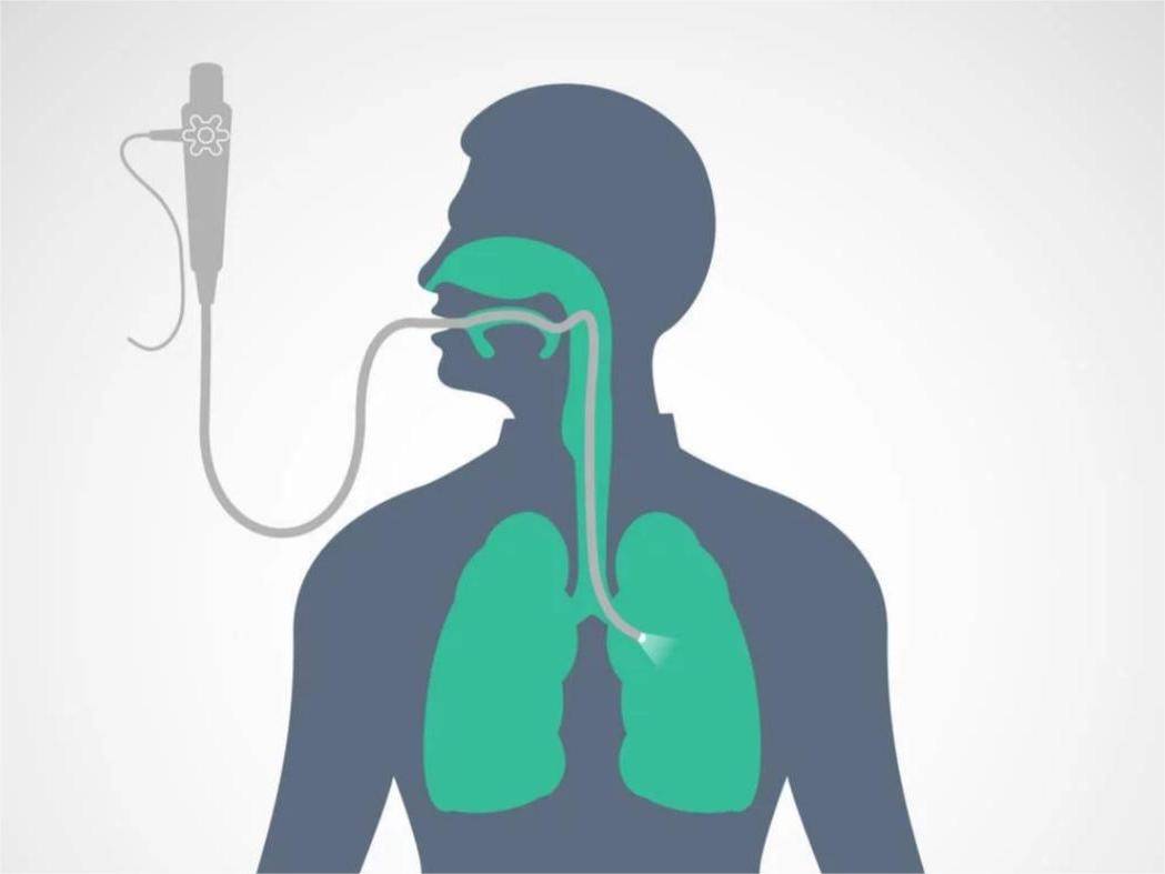 电子支气管镜在医疗实践中的应用_进行_治疗_气道