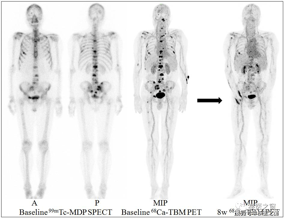 全身骨显像报告解读图片