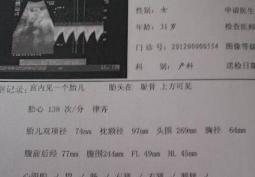 妇科医生表示:孕期做b超并不是越多越好!4个关键时间做了即可!