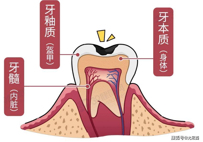 楔形缺損是一種常見的牙齒損傷,表現為牙齒表面出現小而深的裂縫.