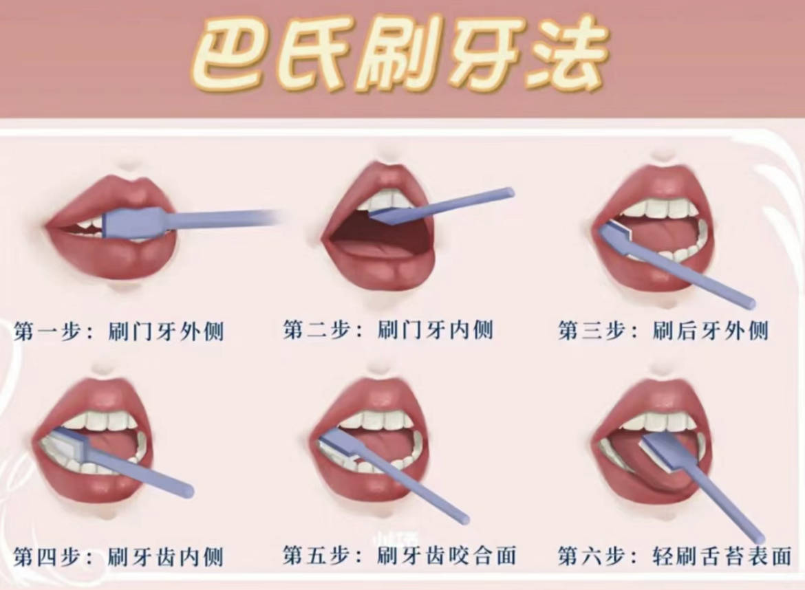 去除牙结石的第一步就是要正确刷牙,每天坚持使用巴氏刷牙法刷牙,这个