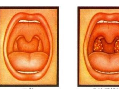 流鼻涕,可见咽部扁桃体充血,扁桃体粘膜及其浅表组织有少量白色分泌物
