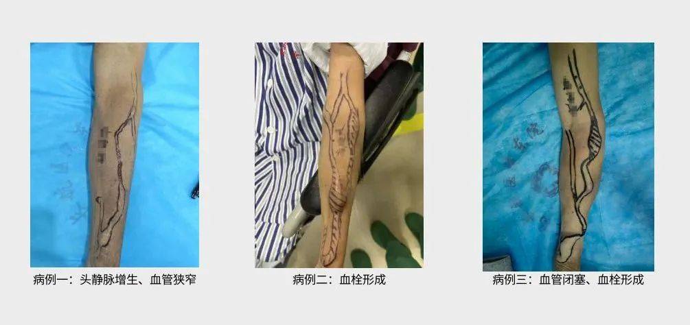 线"——我院成功完成多例动静脉内瘘球囊扩张成形术_净化_心血管_血液