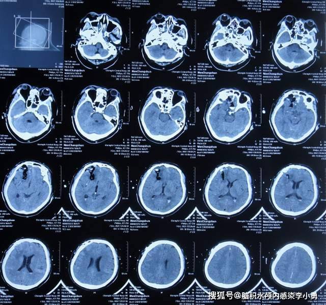 车祸脑外伤术后13天,现脑积水颅内感染致使昏迷,脑脊液鼻漏_给予_治疗