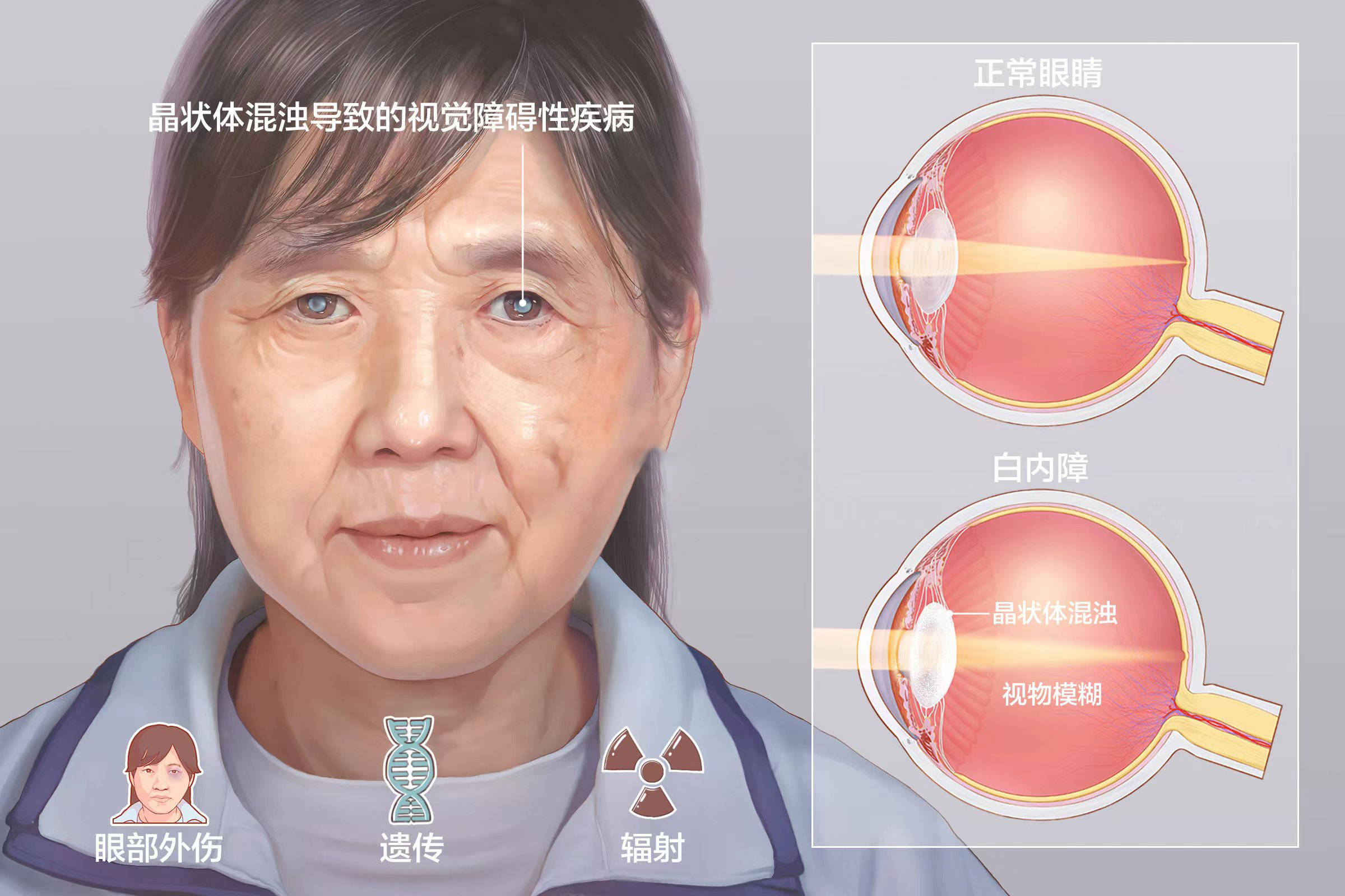 干细胞再生晶状体,助2亿白内障患者告别模糊世界!