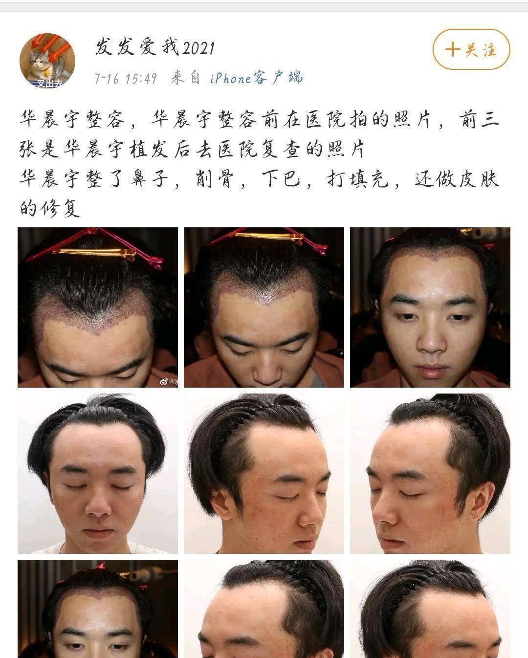 网友称华晨宇是自己老公,还晒出多张华晨宇植发照片,称张碧晨是小三