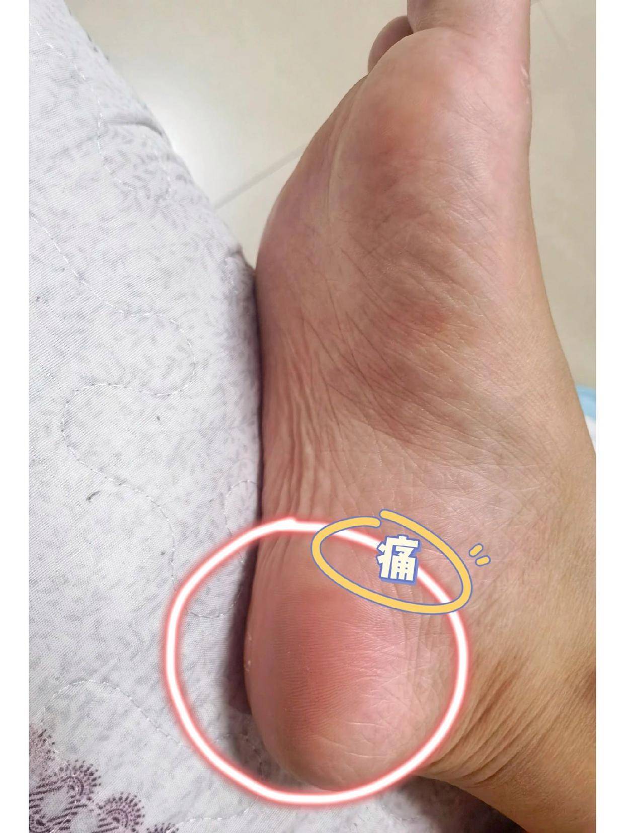 足跟疼痛,不要觉得忍就能好,三个方法教你彻底解决足底筋膜炎!