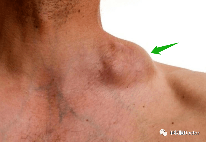 警告:颈部出现这3种症状,有可能是甲状腺癌