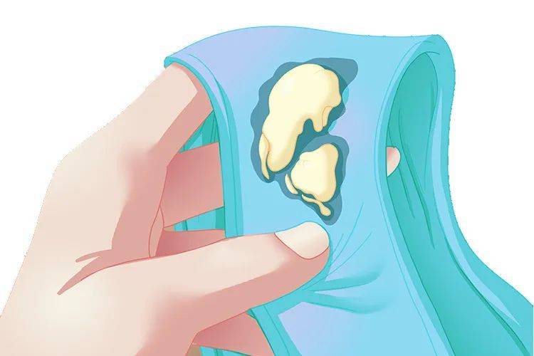 如何通过白带辨别健康,白带出现这些情况,当心是盆腔炎