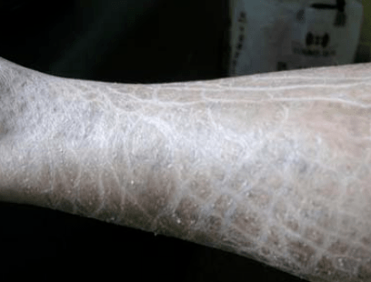 是皮肤干燥,还是得了皮肤病?_专科医院_有关_治疗