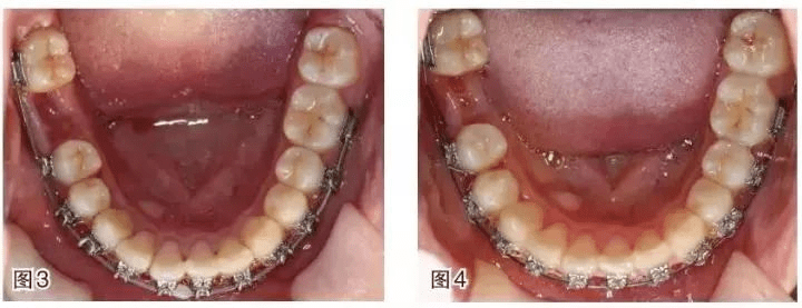 ds正畸| 磨牙近中移動的正畸臨床案例_下頜_平移_患者