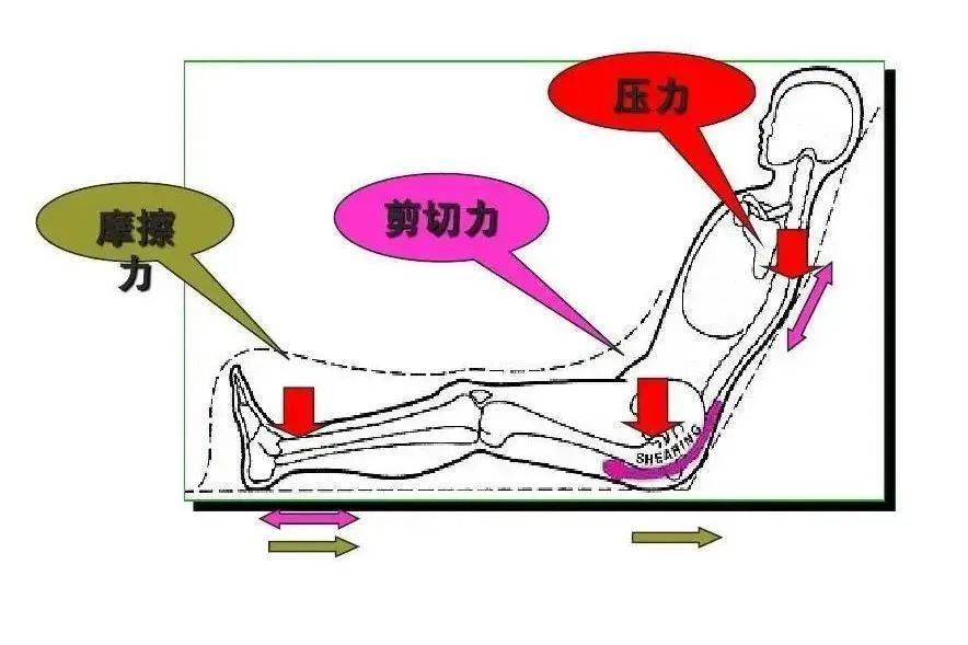 压疮,古时候称"席疮",又叫"褥疮",它是由于压力或压力联合剪切力引起