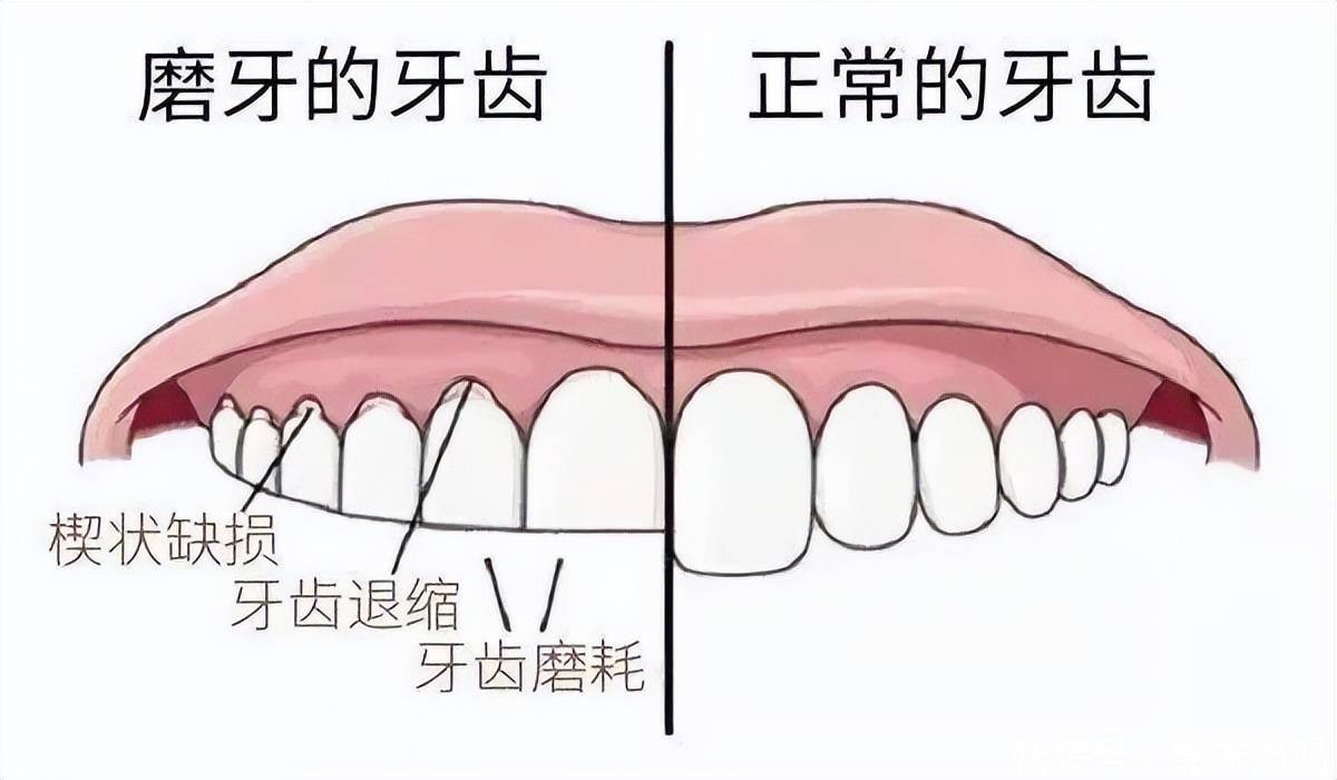 牙周炎危害嚴重,務必戒備17大口腔護理禁忌潛規則!_問題_患者_牙齦