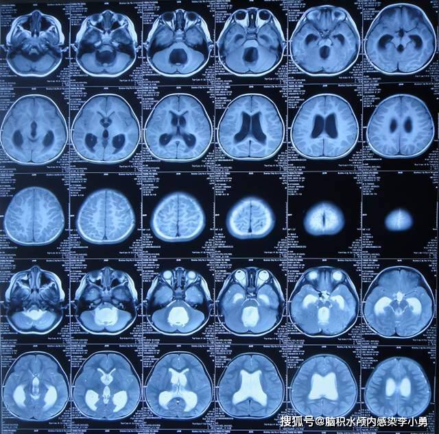 幼童第四脑室反常扩大型脑积水分流术后复发,发热呕吐头痛走不稳