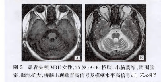 橄榄桥脑小脑萎缩的mri诊断与表现