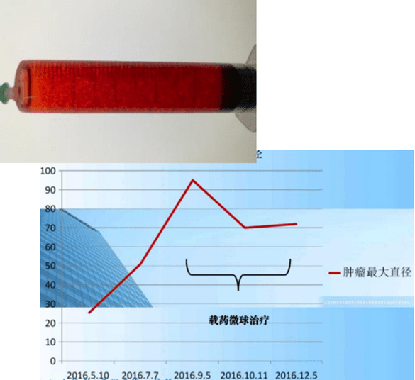 該方法已被證實對原發性和轉移性肝癌有效,同時相比化療,釔-90微球