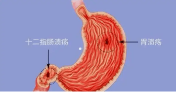 希洛施 泮托拉唑鈉腸溶片:白天沒事,一到晚上就胃疼是怎麼回事?