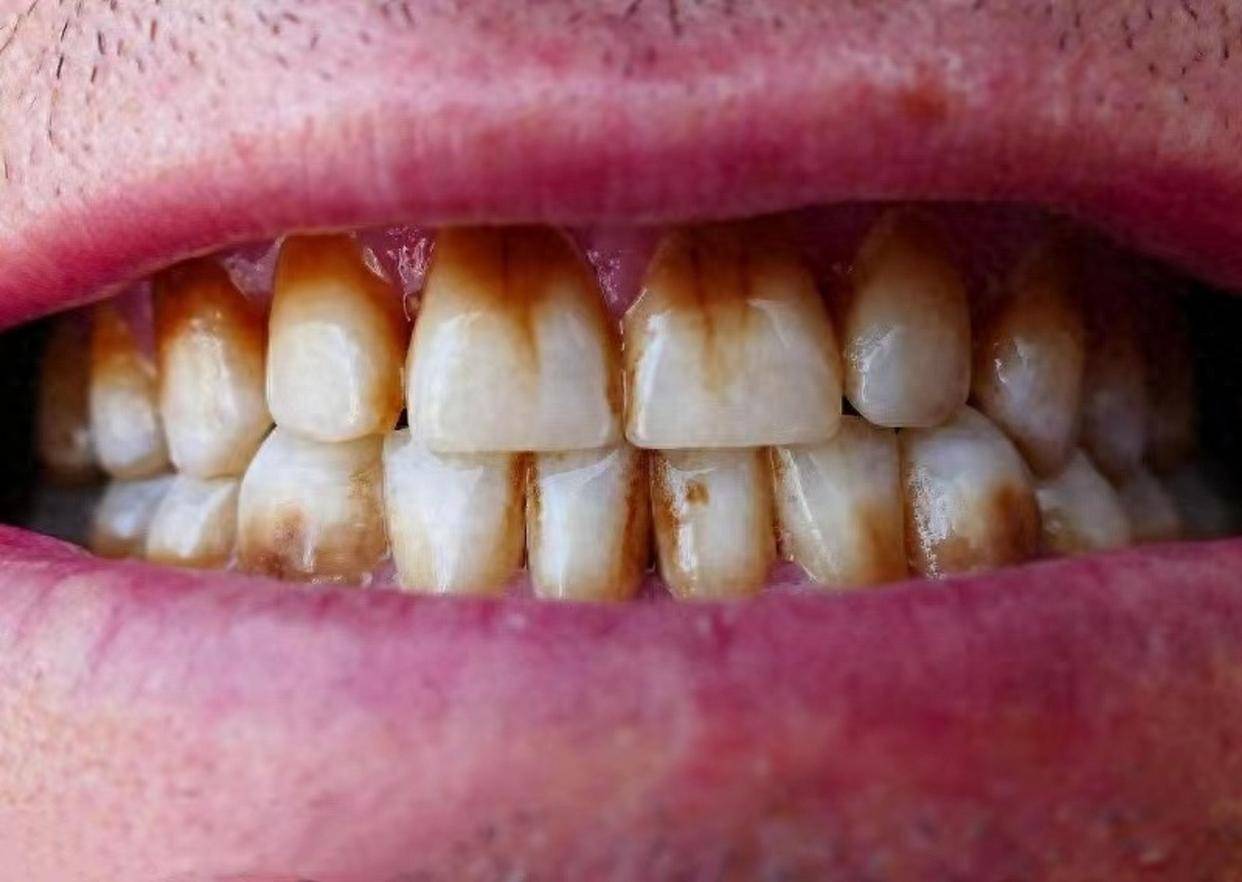 牙黄烟渍3招在家刷掉!牙齿瞬间亮白如新!学会一个终身受益!