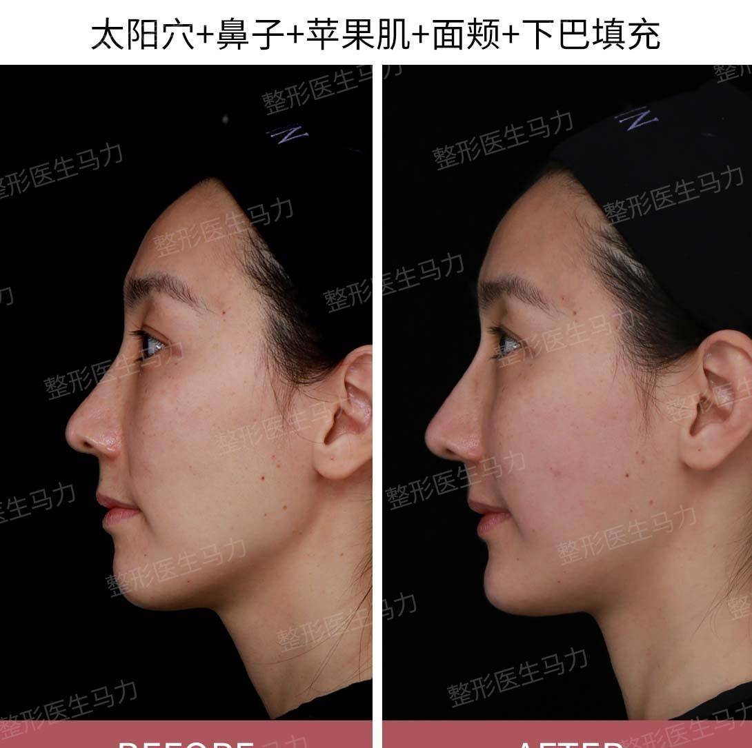 并对苹果肌进行支撑时,印度纹和法令纹都会得到一定程度的改善,面部