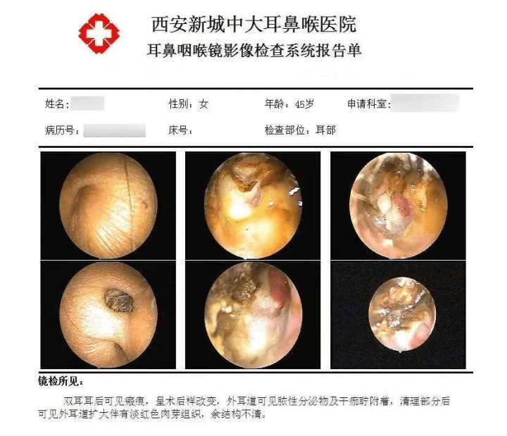 中耳胆脂瘤手术切口图图片