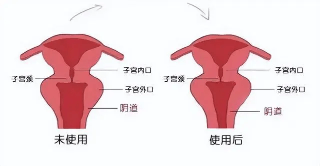 顺产后总觉得下面口大图片