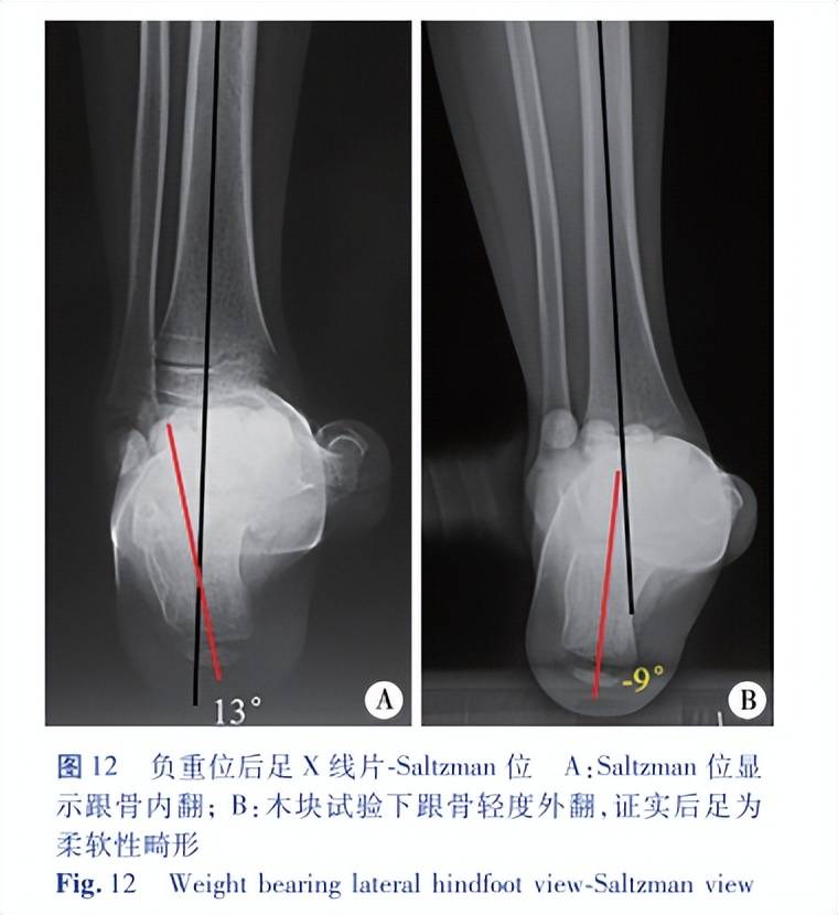 北京大榮診所足踝醫生胡霞:兒童高弓足畸形的影像學評估_縱軸_脛骨