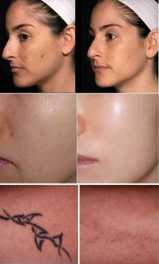 超皮秒激光祛斑的危害与效果,超皮秒祛斑的危害与效果会反弹吗?