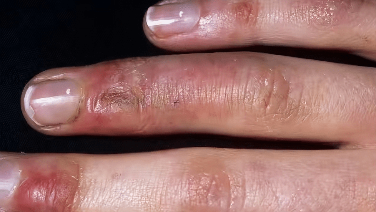 每天坚持3习惯,在家轻松止痒消红!_手部_皮肤_朋友