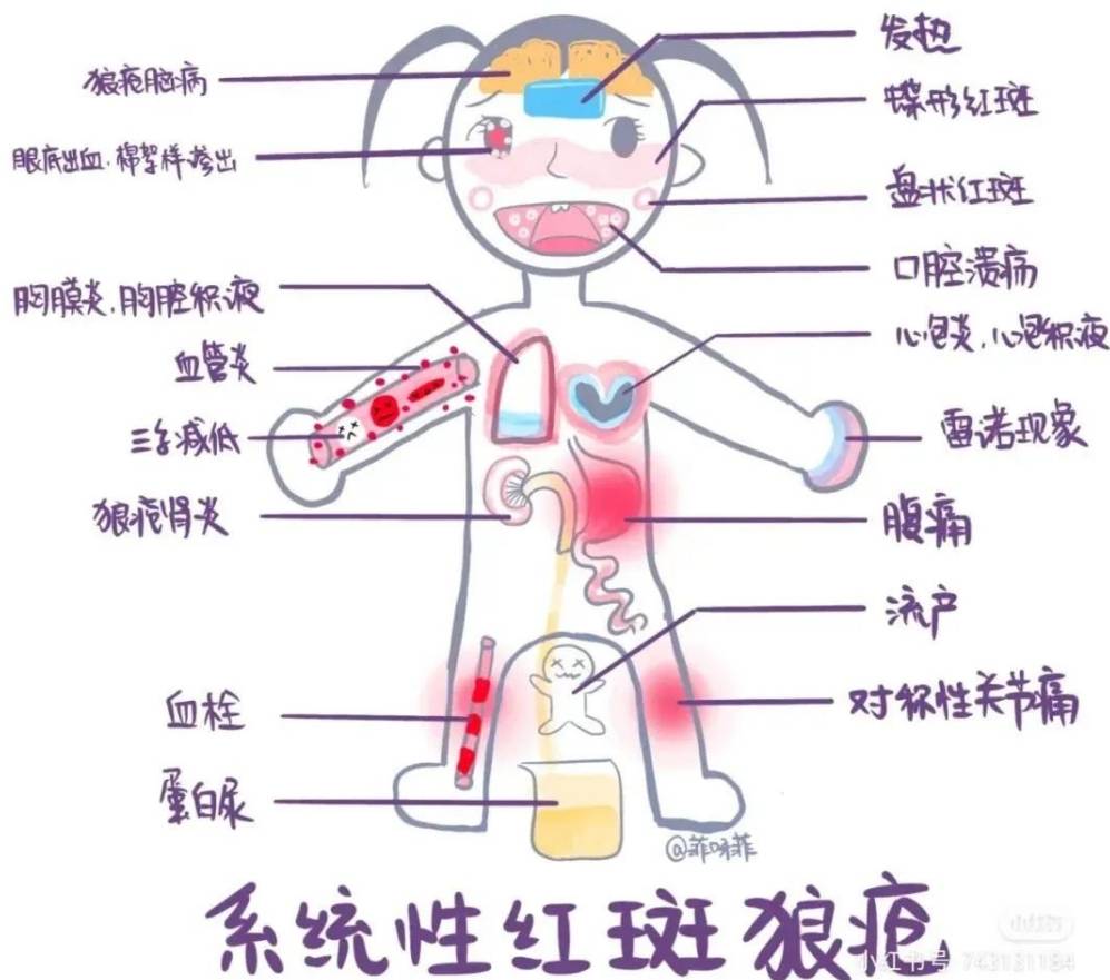 红斑狼疮会传染身边的人吗