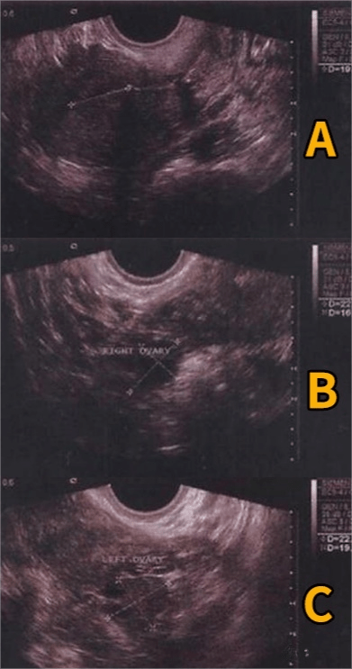 卵巢早衰治疗新突破!干细胞疗法让闭经女性重获新生!_患者_内膜_子宫