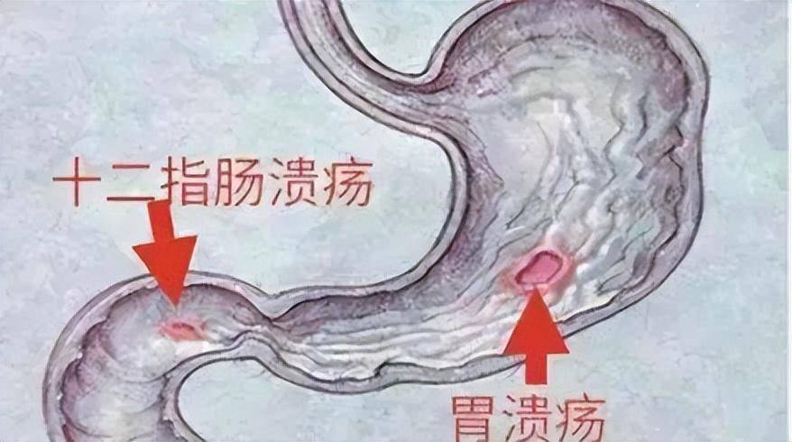 胃潰瘍怎麼回事?出現這6個症狀,要小心!_治療_醫生_藥物