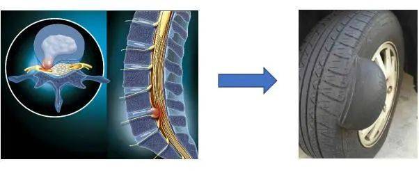 腰椎盘图片的l4l5图片