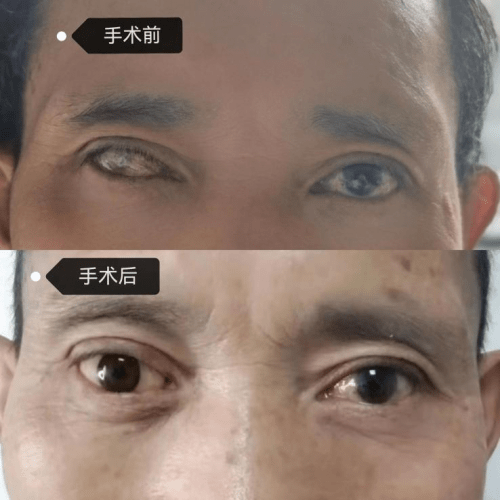 男子右眼失明眼球萎缩,公益救助义眼手术后重获新生
