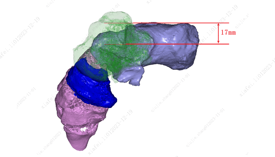 骨科三維重建&手術設計——右跟骨內翻畸形矯形手術三維分析方案_技術