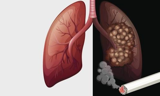 查出肺癌时大多已是晚期？若发出3种“信号”，可能癌细胞在敲门