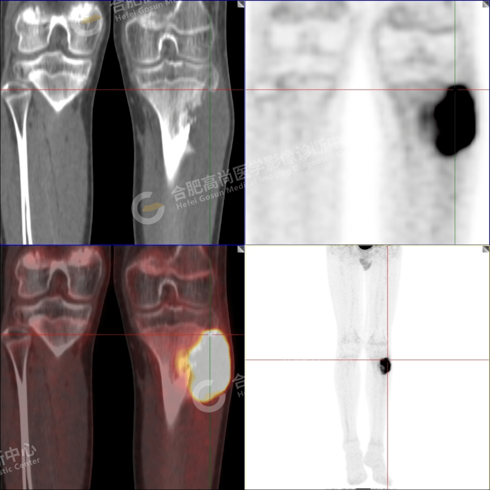 【高尚病例】pet/ct诊断儿童骨肉瘤2例